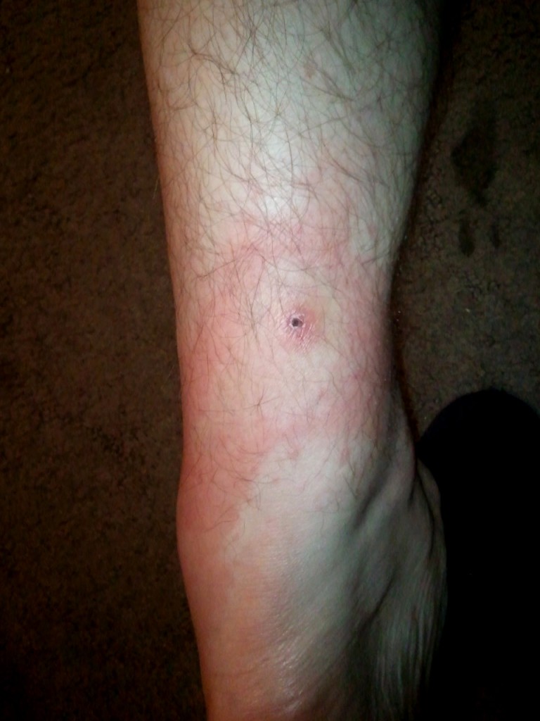 lyme-1